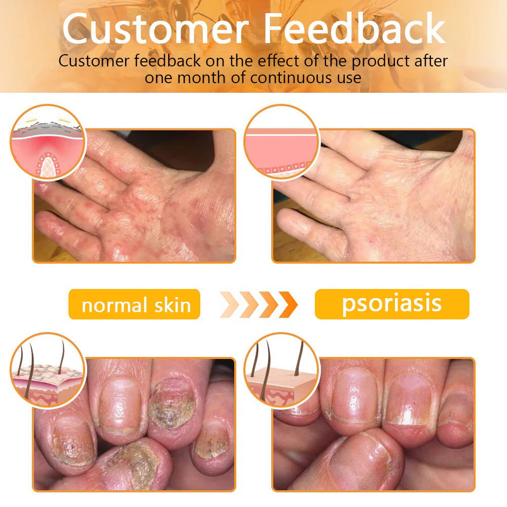 ๐๐๐๐ข๐๐๐๐ขโข Bee Venom Skin Treatment Cream๏ผ๐ด๐ด๐ท ๐
๐๐๐๐๐๐๐๐๐๐๏ผ๐