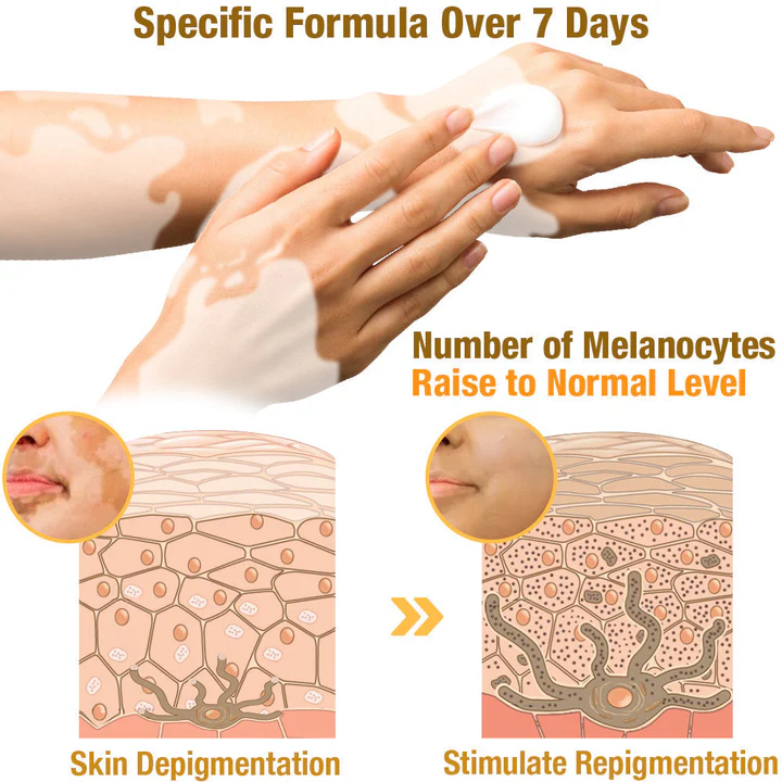 Aeehfeng™ BeeVenom Vitiligo Treatment Cream