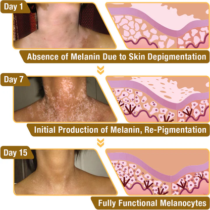 Aeehfeng™ BeeVenom Vitiligo Treatment Cream