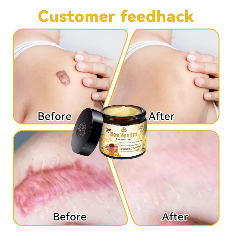 🔥𝑇𝑢𝑟𝑜𝑛𝑢™ Bee Venom Skin Treatment Cream（𝐴𝐴𝐷 𝑅𝑒𝑐𝑜𝑚𝑚𝑒𝑛𝑑𝑒𝑑）