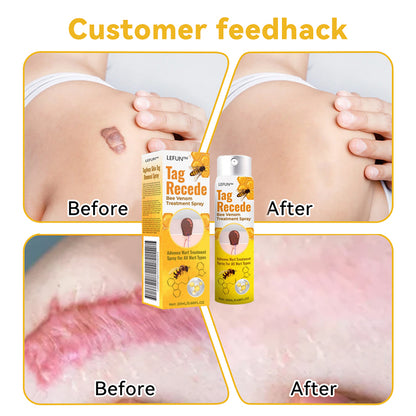 （AAD Recommended）🎁LEFUN™ TagRecede Bee Venom Treatment Spray (✨Last day promotion 80% off)🐝