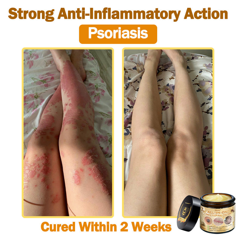 [Official Brand Store] ✅ Lenaro™ Bee Venom All-in-One Cream US Dermatologist Approved (👩‍⚕️ American Academy of Dermatology 2025 Specially Recommended Product) 🎉