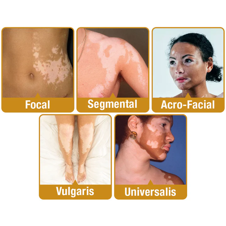 Aeehfeng™ BeeVenom Vitiligo Treatment Cream