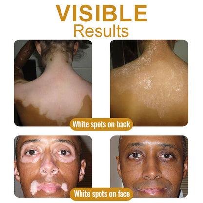 Aeehfeng™ BeeVenom Vitiligo Treatment Cream